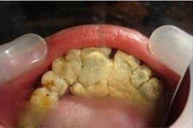 牙结石没了！过来人分享3个自用小妙招！(图1)