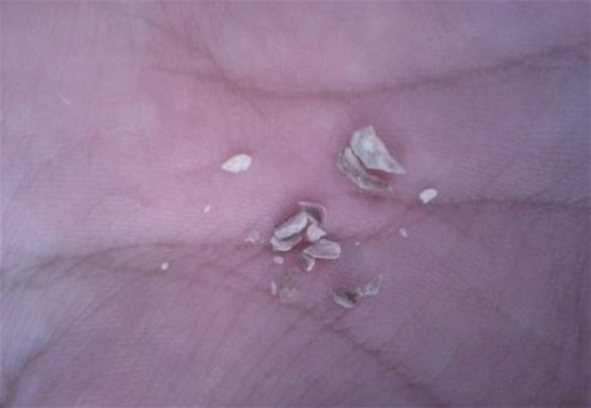 彩神牙结石不用洗牙！过来人分享生活小妙招！！(图5)